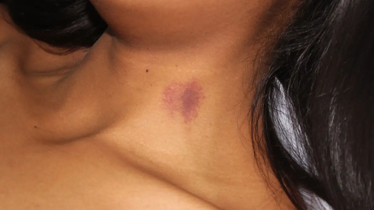 Achtung, Knutschfleck! Mit diesen Tipps kannst du die Liebesmale entfernen