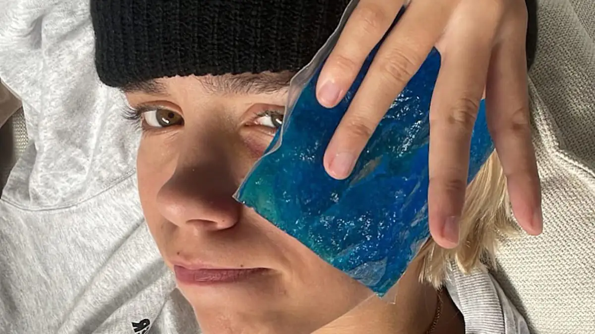 Influencerin Lena Mantler kassiert blaues Auge