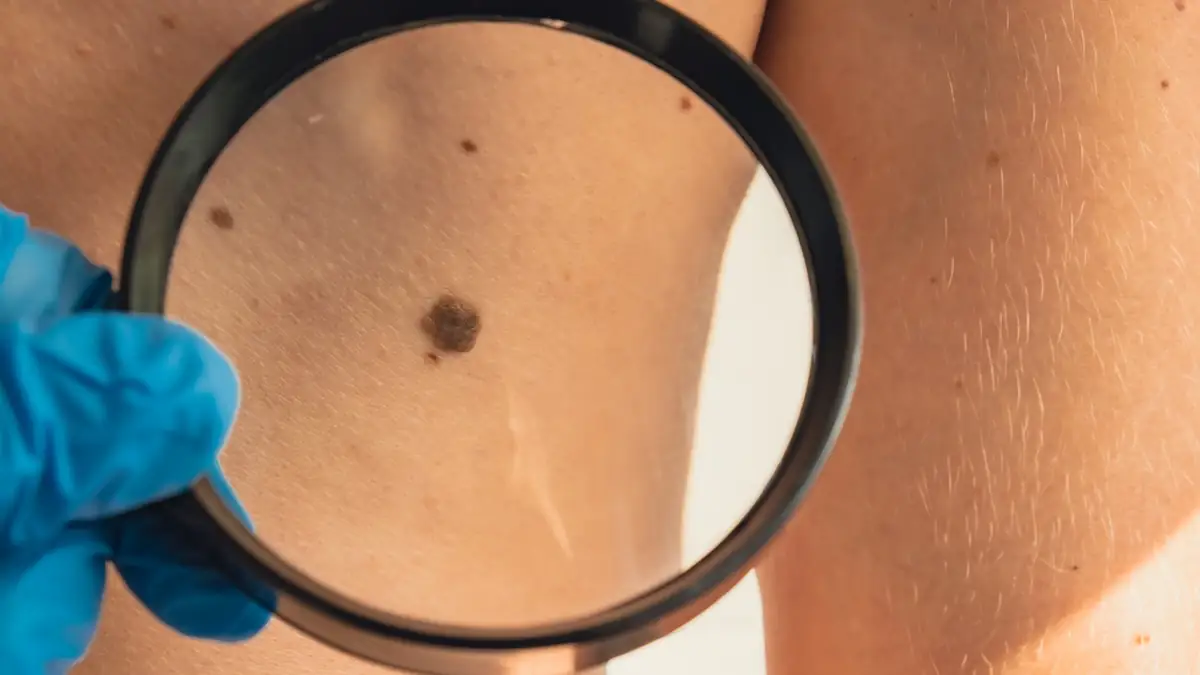 Hautkrebs Symbolbild: Leberfleck am Rücken wird mit einer Lupe untersucht
