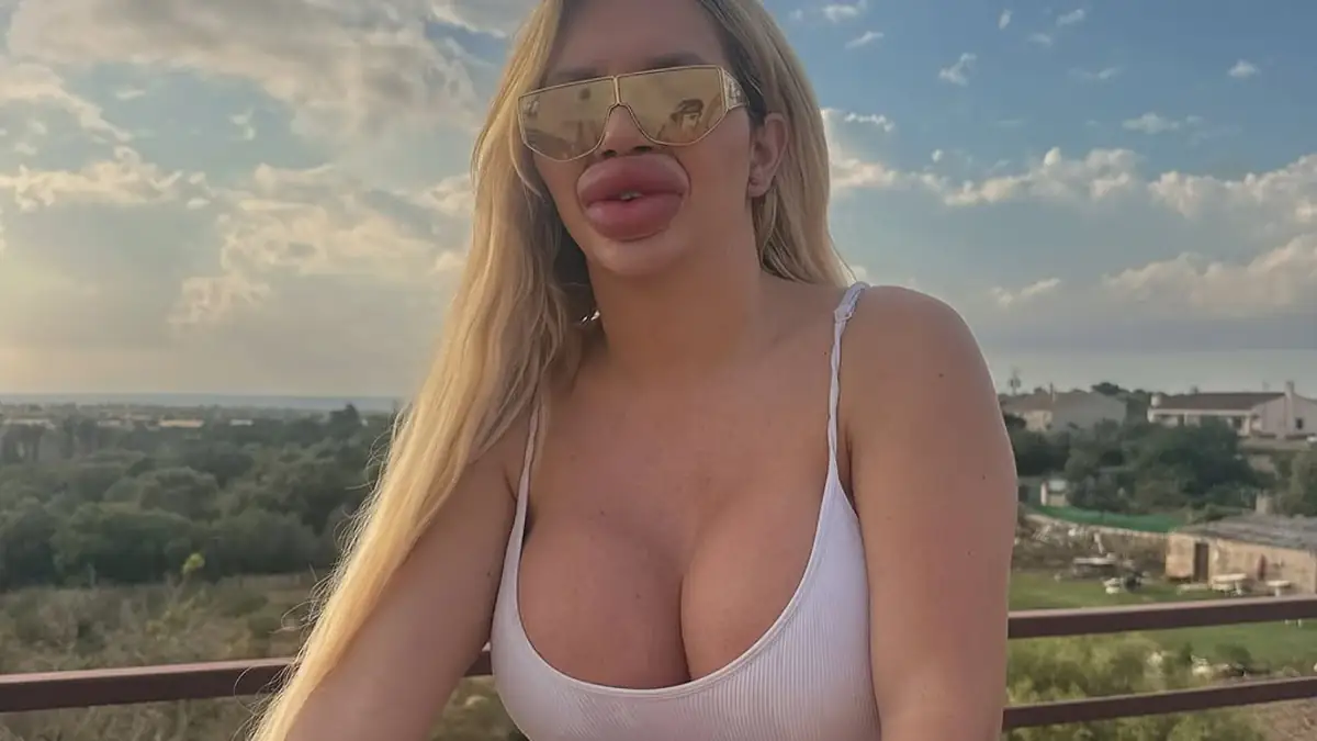 Sie gab schon über 43.000 Euro aus: Influencerin wünscht sich die dicksten Lippen der Welt