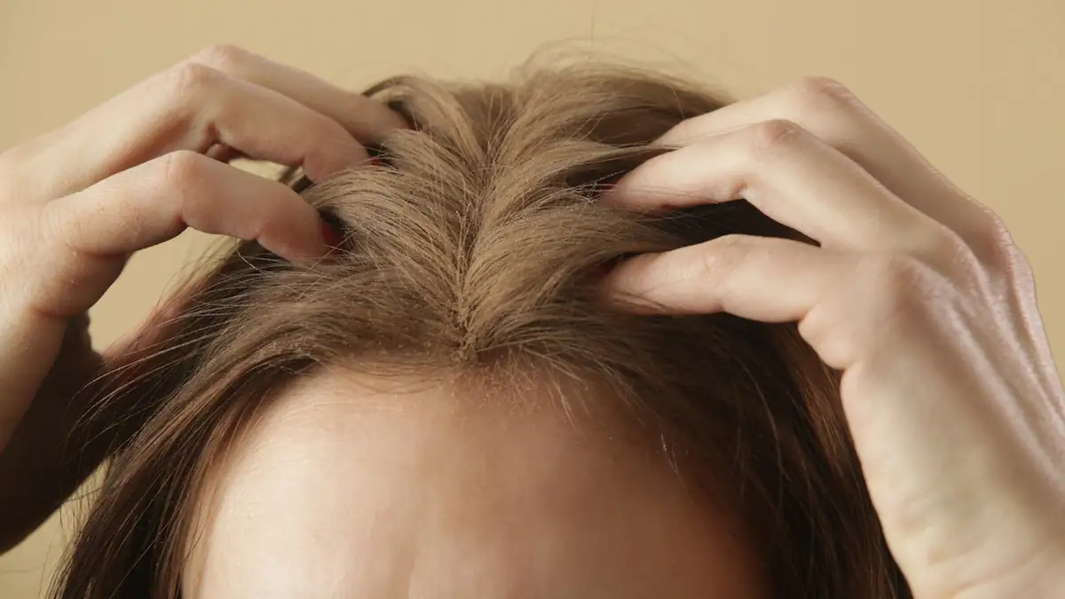 Helle Trockenshampoo-Rückstände in braunen Haaren