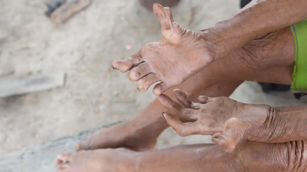Durch Lepra verformte Hände einer Frau