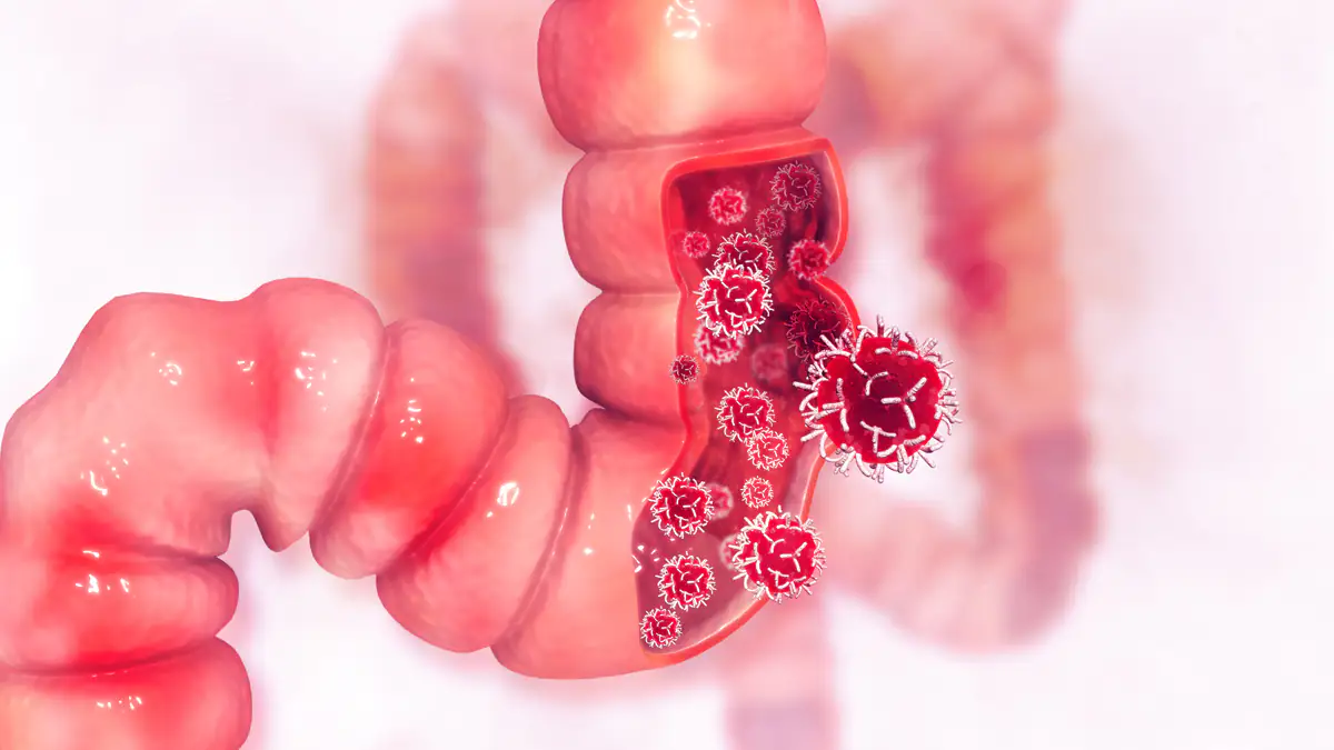 Darmkrebs: Forschern gelingt überraschender Heilungserfolg