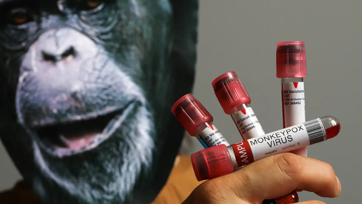 Übertragung durch Sex? Affenpocken-Viren in Sperma entdeckt