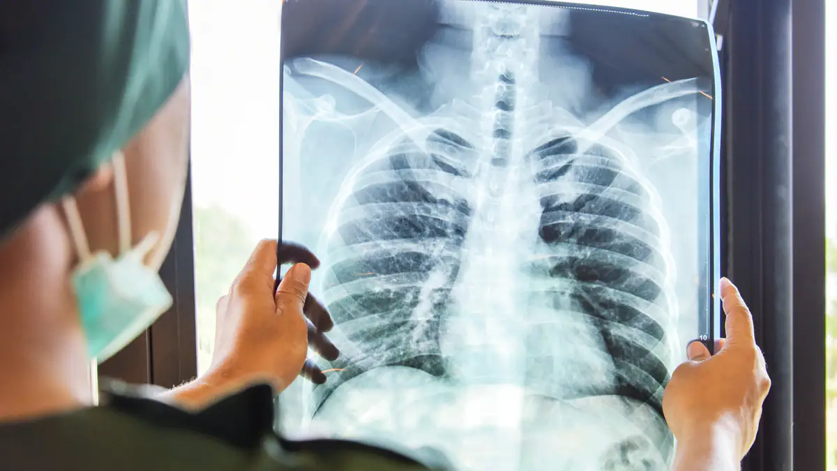 Schon 25 Betroffene: Tuberkulose breitet sich in Chemnitz aus