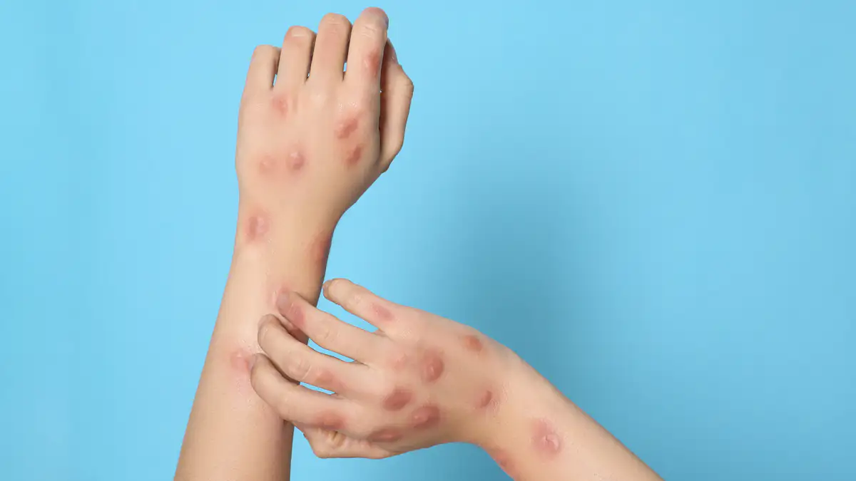 MPOX-Virus breitet sich aus – „Risiko für die ganze Welt“