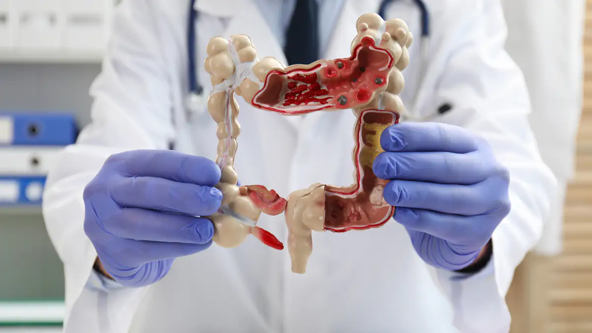 Mediziner warnt vor 5 Symptomen, die auf Darmkrebs hindeuten können