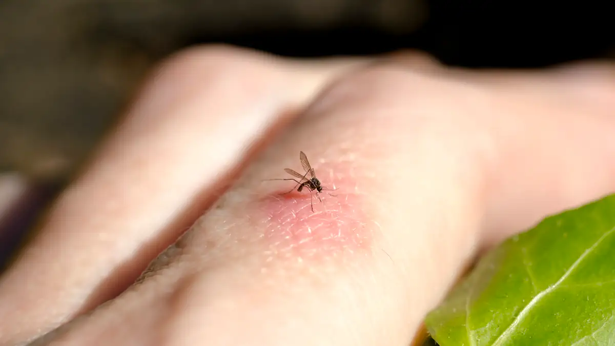 Mückenstich mit Mücke auf einem Finger