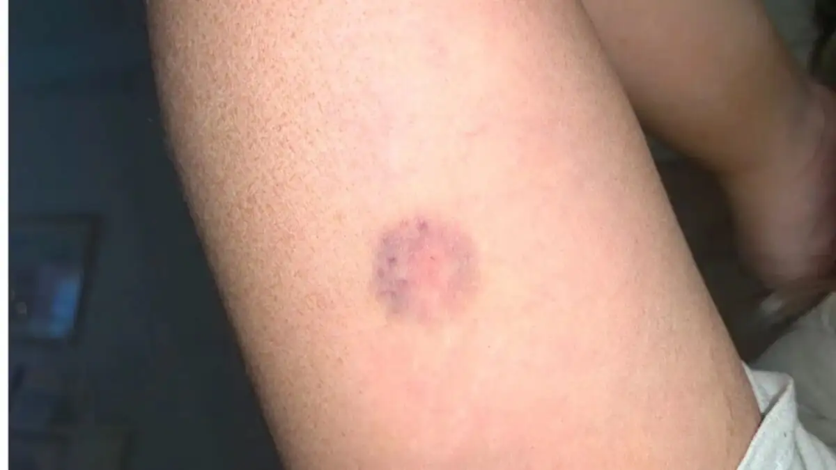 Needle Spiking Einstichstelle am Arm