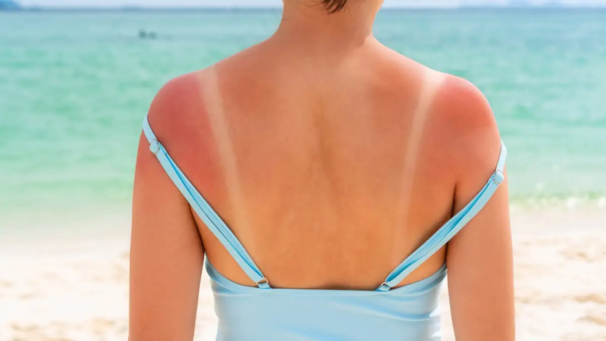 Junge Frau mit Sonnenbrand am Rücken