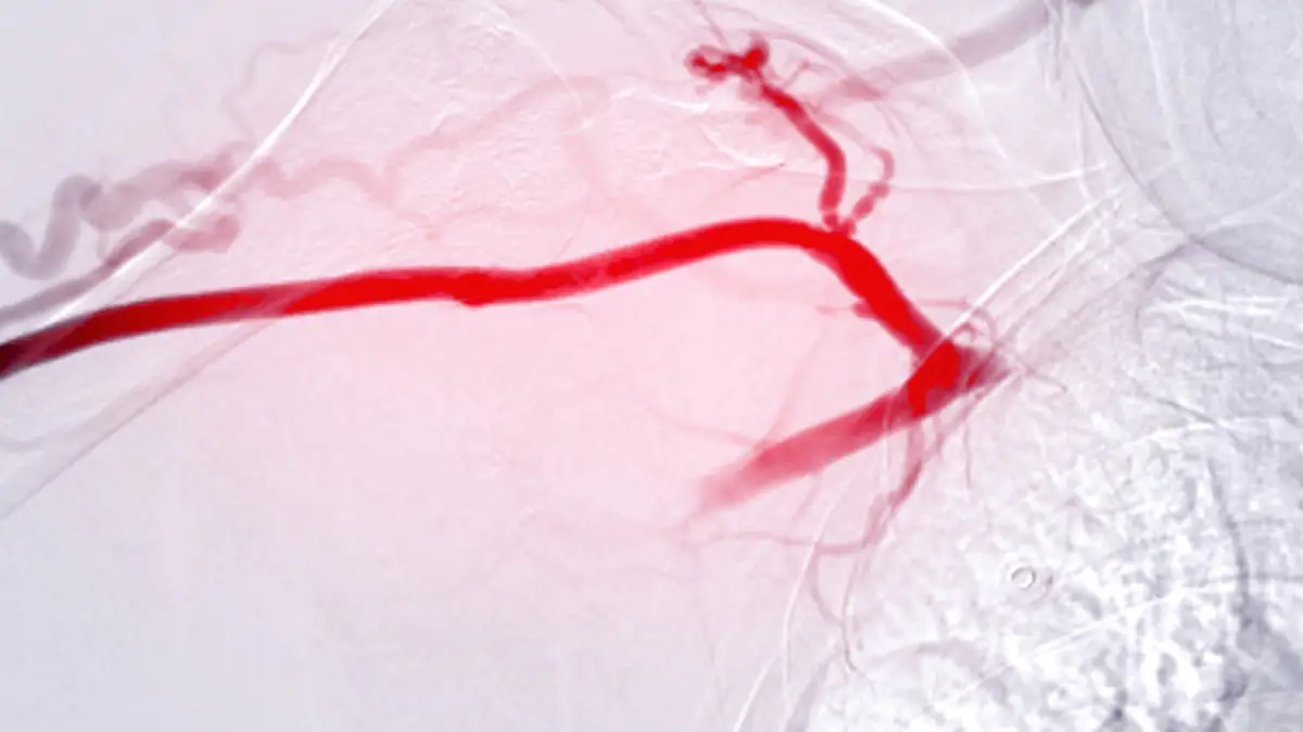 Verkalkte Arterien: Bild der Angioplastie, Ballonangioplastie und perkutanen transluminalen Angioplastie (PTA) .