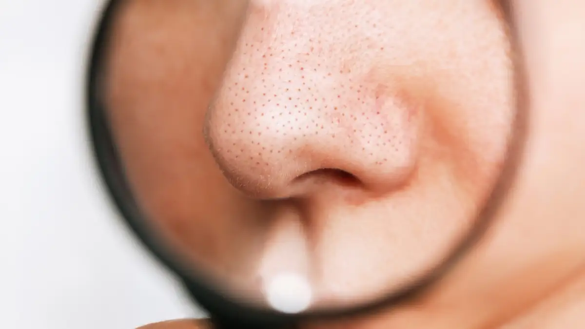 Sehen aus wie Mitesser: Dermatologin warnt davor,  die schwarzen Punkte auf der Nase auszudrücken