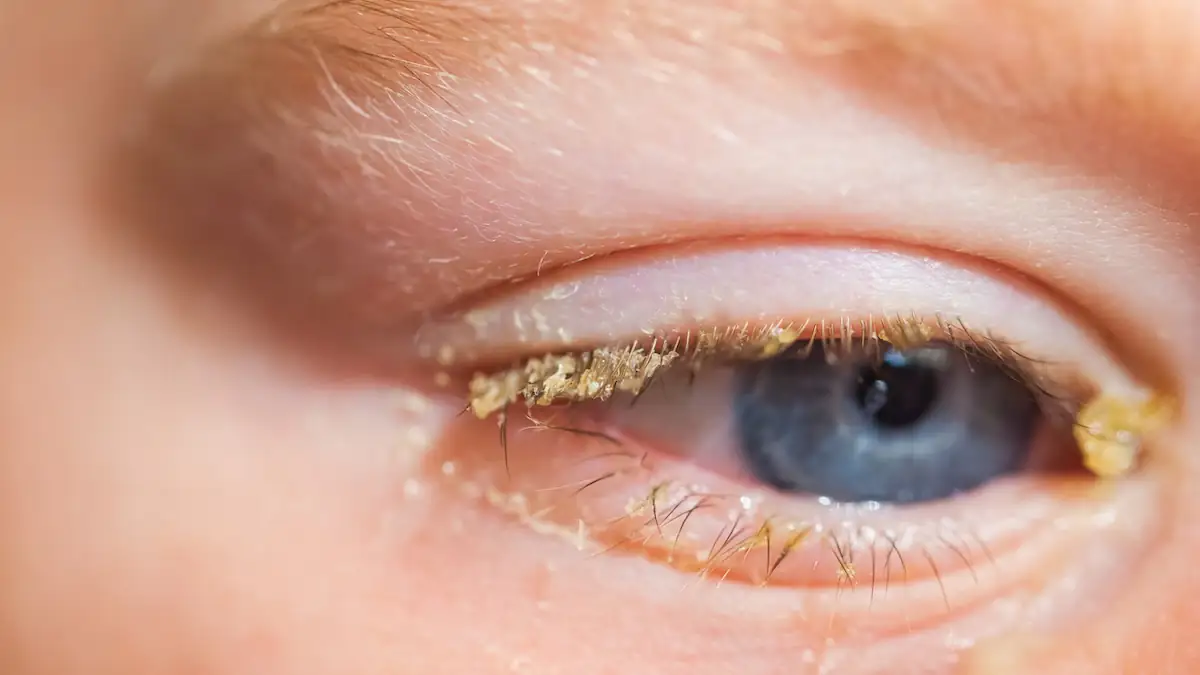 Gelber „Schlafsand“ im Auge: Viele kennen die eklige Wahrheit dahinter nicht